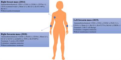 Case Report: Combined Intravenous Infusion and Local Injection of CAR-T Cells Induced Remission in a Relapsed Diffuse Large B-Cell Lymphoma Patient